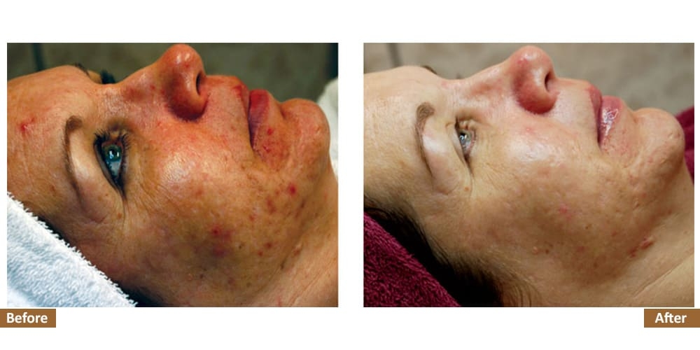 Holistic Acne Program Before & After Treatment Image