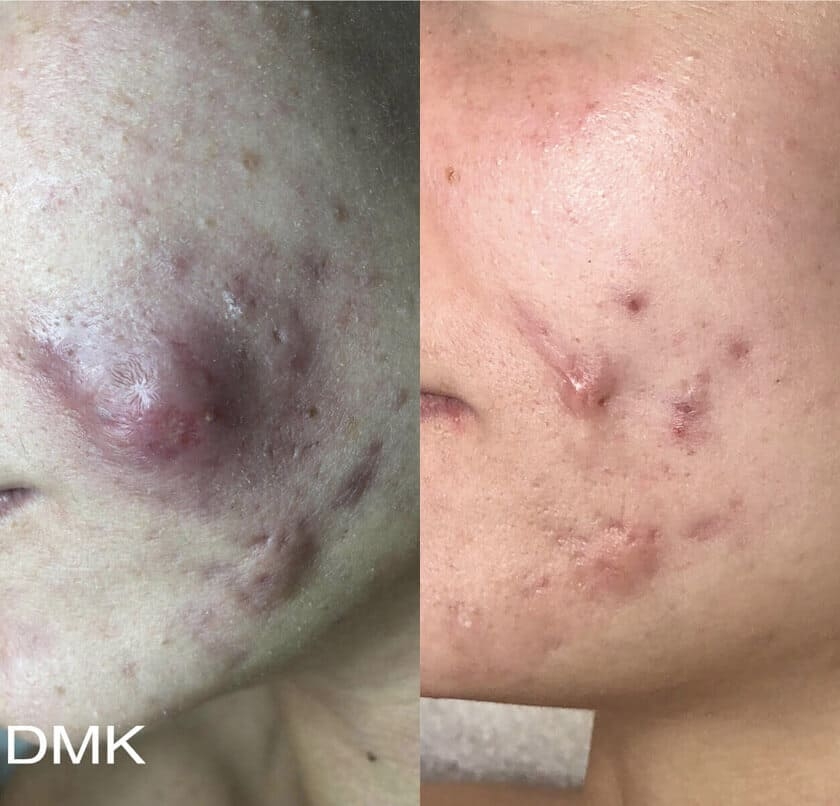 DMK Enzyme Therapy Before & After