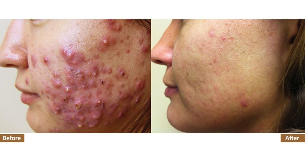 Holistic Acne Program Before & After Treatment Image