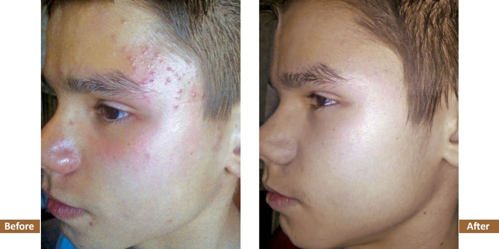 Holistic Acne Program Before & After Treatment Image