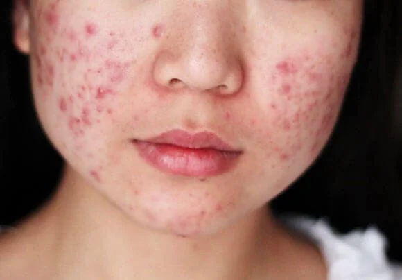 Cystic Acne Treatment
