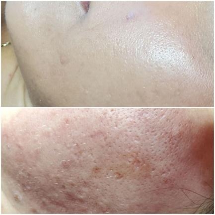 Restorative Bio Peel Before & After