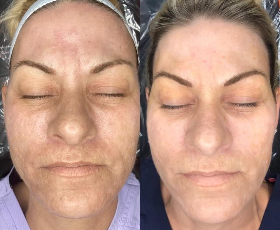 Microneedling Before & After Treatment at Essence of Beauty Ottawa