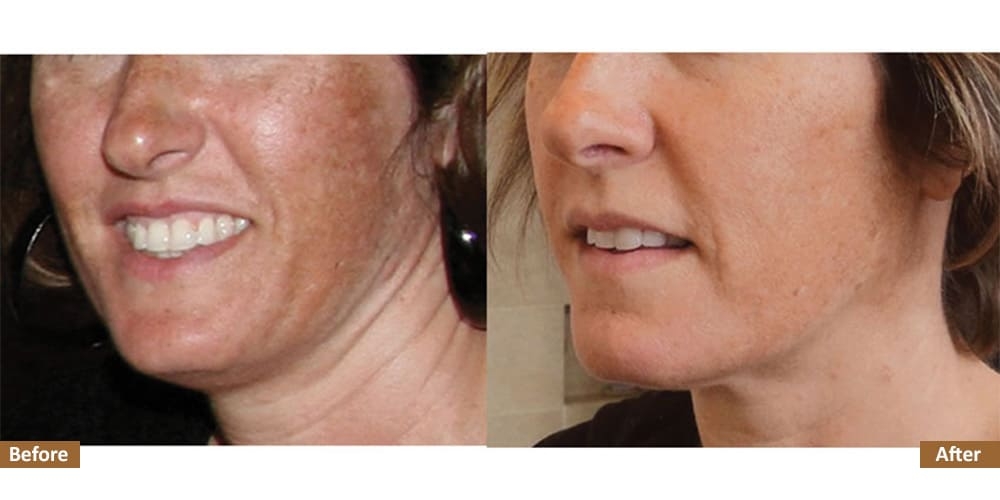 Hyperpigmentation & Melasma Before & Treatment Image