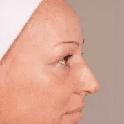 Essence of Beauty Herbal Green Peel®