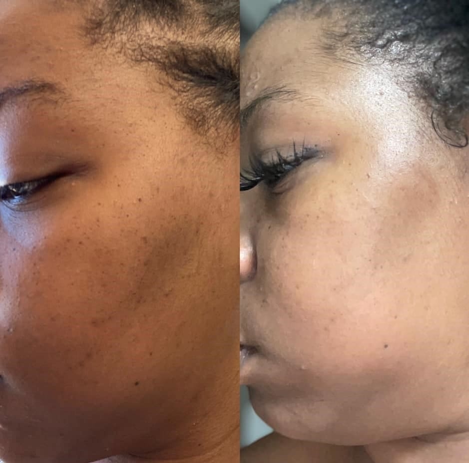 AfterGlow Peel Before & After Treatment