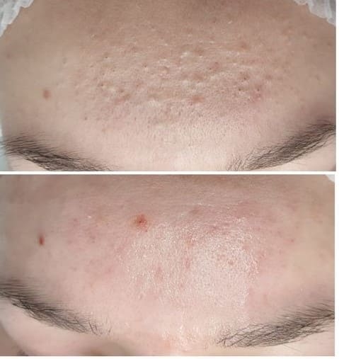 Before & After Acne Treatment