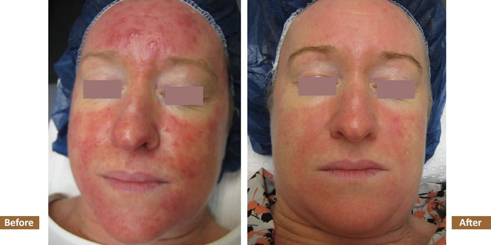 Rosacea Before & After Treatment Image