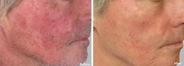 AnteAge Before & After Treatment